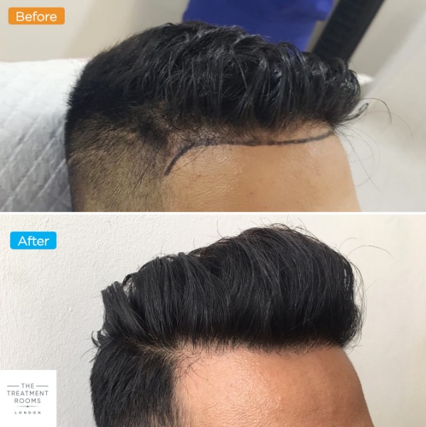 Right temporal hairline transplant